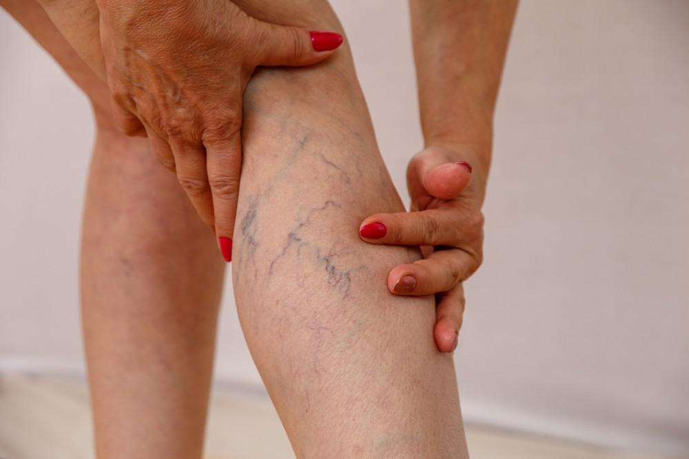 What are varicose veins? Prevention