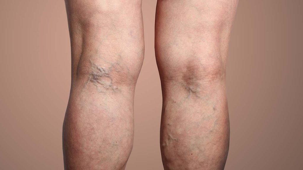 Spider Veins vs. Reticular Veins - What's the Difference?