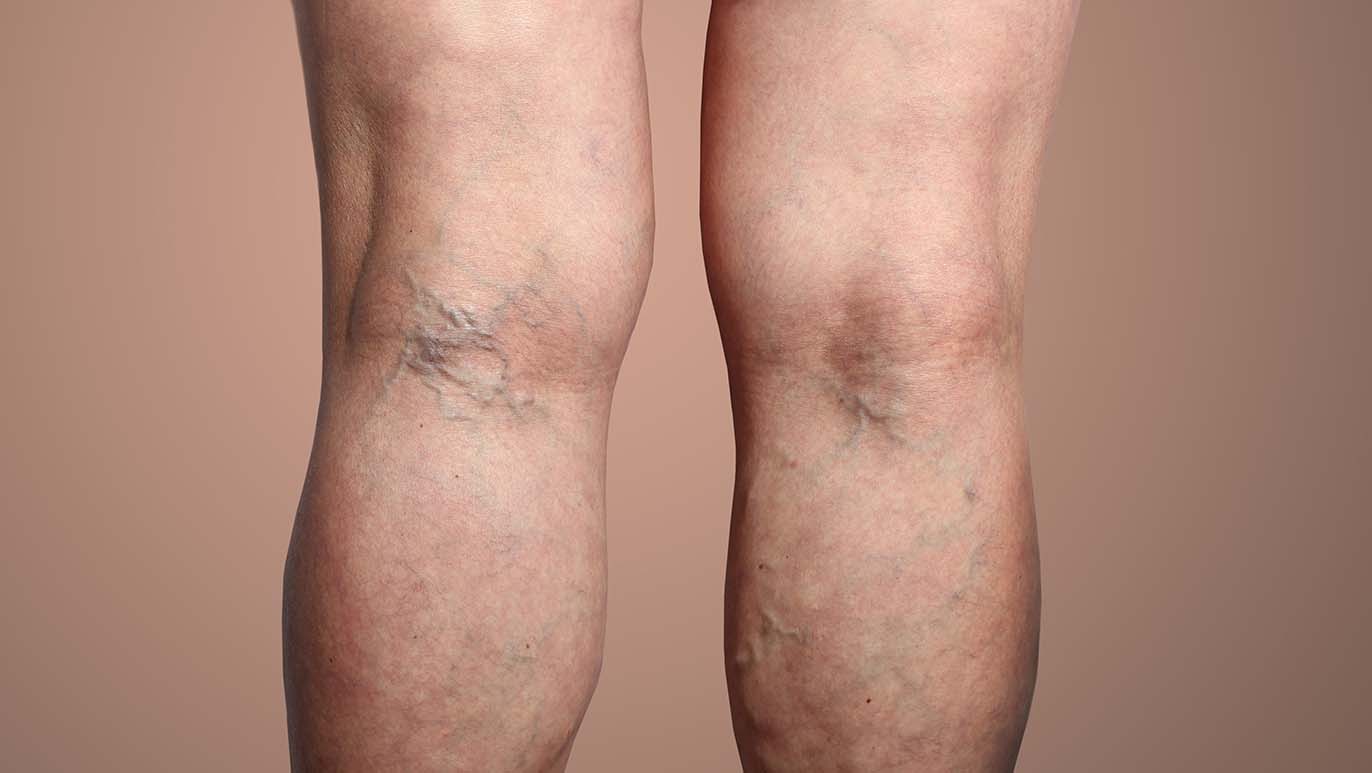 Can Varicose Veins Cause Skin Discoloration?: Center for Varicose Veins:  Board Certified Vascular and Interventional Radiologists